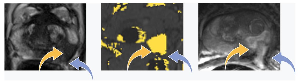 MR images of a prostate with a lesion near a nerve bundle before, during, and after FLA procedure