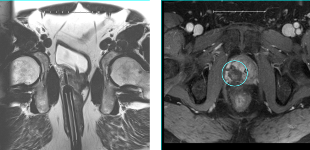 Focal Laser Ablation Before After