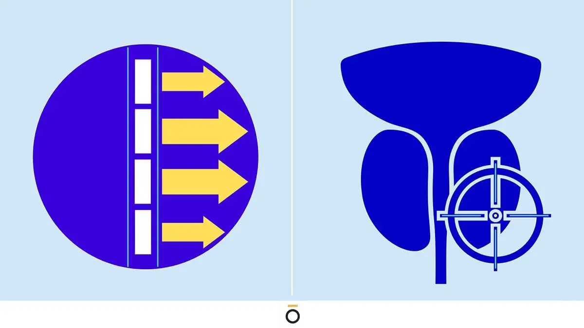 TULSA vs Laser Focual Therapy Prostate Barrier Illustration