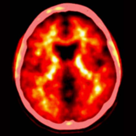 Amyloid Negative