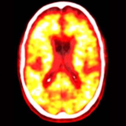 Amyloid Positive