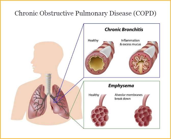 Copd Diagram