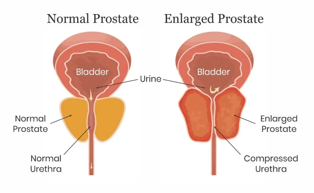 Enlarged Prostate