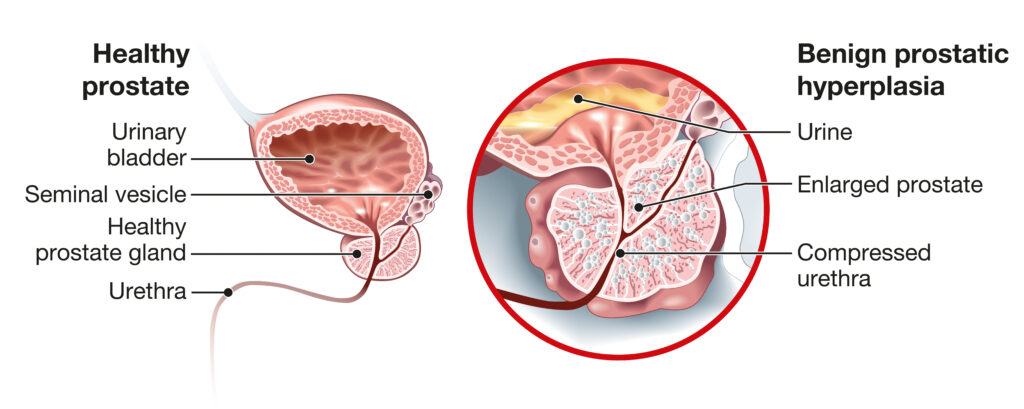 A normal prostate compared to an enlarged prostate