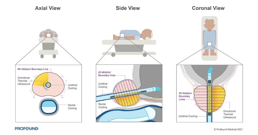 Tulsa Prostate Ablation