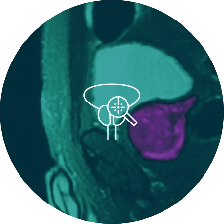 Prostate Scan with icon of prostate on it