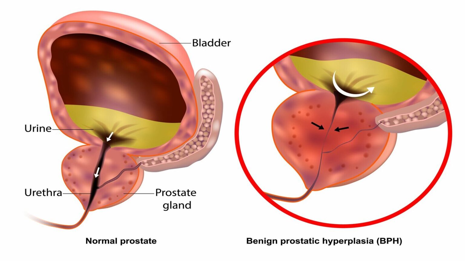A man's normal sized prostate compared to his now enlarged prostate due to benign prostatic hyperplasia