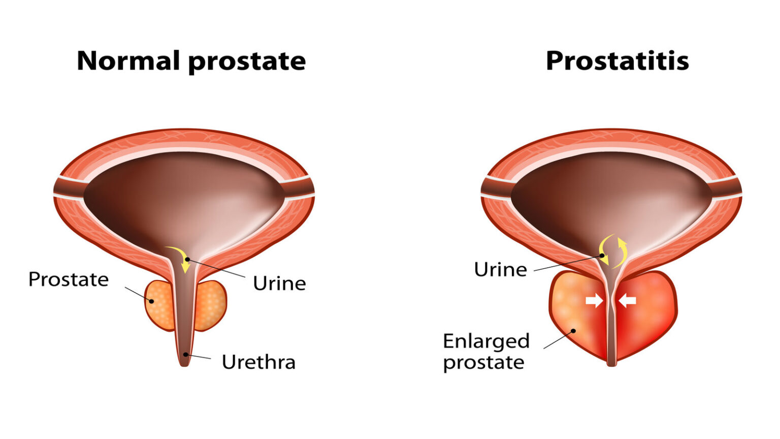 A visual representation of how BPH can lead to swelling in a male's prostate