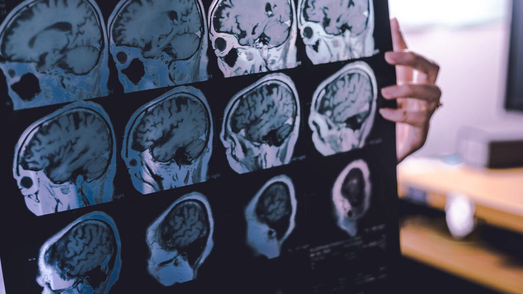 Frontal Lobe Atrophy On Mri Film Probably Frontotemporal Dementi